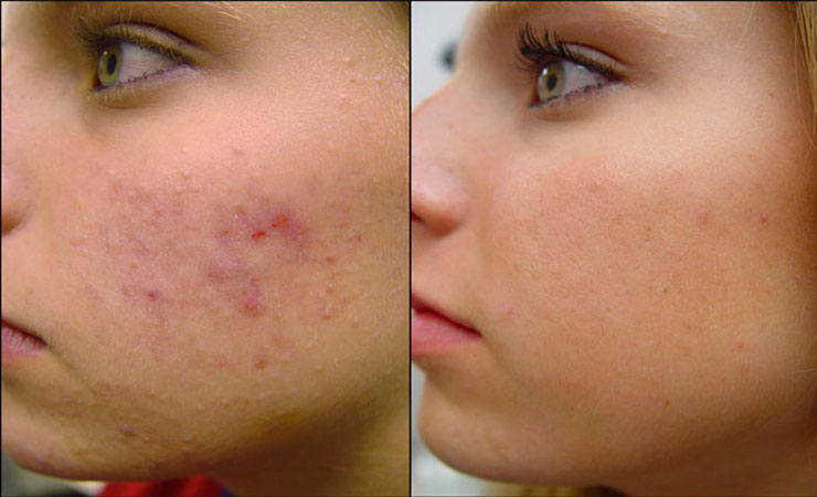 acne_pimples
